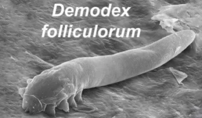 Gözde yanma, sulanma ve kaşıntı varsa Demodex Parazitine dikkat !